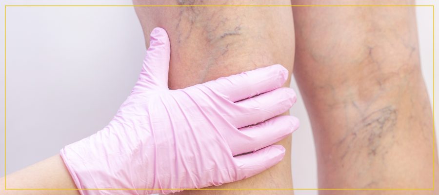 Spider Vein Treatment Near Me in Newington NH Spider Vein Treatment Near Me in Newington NH