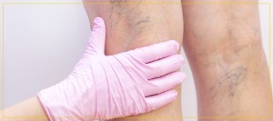 Spider Vein Treatment Near Me in Newington NH Spider Vein Treatment Near Me in Newington NH