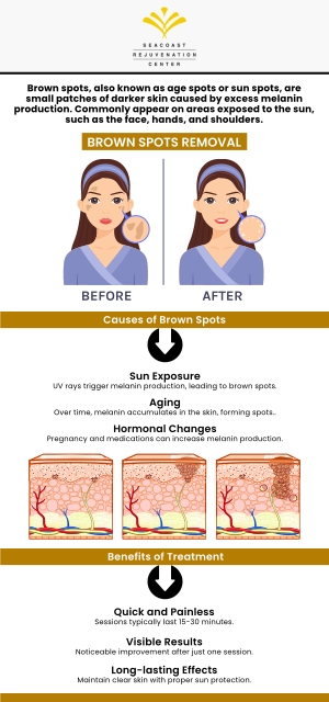 At Seacoast Rejuvenation Center we offer various treatment options for the removal of brown spots. We are open 5 days a week for your convenience. For more information, contact us or schedule an appointment online. Our med spa is conveniently located at 101 Shattuck Way Suite #1 Newington, NH 03801. At Seacoast Rejuvenation Center we offer various treatment options for the removal of brown spots. We are open 5 days a week for your convenience. For more information, contact us or schedule an appointment online. Our med spa is conveniently located at 101 Shattuck Way Suite #1 Newington, NH 03801.