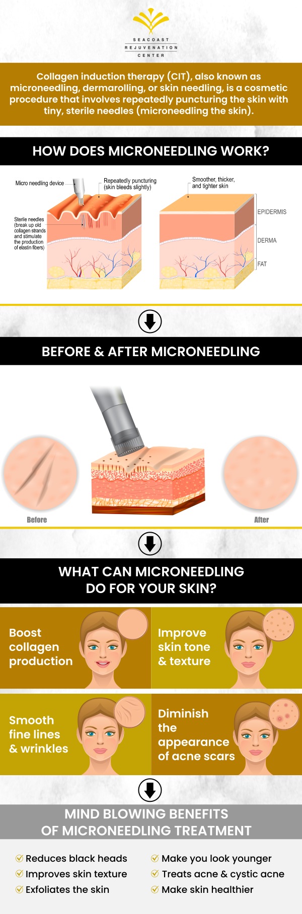 RF microneedling uses the addition of an RF energy technology that is transferred through the tiny needles below the skin’s surface to the deep layers of tissue of the epidermis. Look younger with smoother skin. Talk to our team of professionals at Seacoast Rejuvenation Center today about RF microneedling and its benefits. Contact us today or visit us online to book an appointment. We are conveniently located at 101 Shattuck Way Suite #1 Newington, NH 03801. RF microneedling uses the addition of an RF energy technology that is transferred through the tiny needles below the skin’s surface to the deep layers of tissue of the epidermis. Look younger with smoother skin. Talk to our team of professionals at Seacoast Rejuvenation Center today about RF microneedling and its benefits. Contact us today or visit us online to book an appointment. We are conveniently located at 101 Shattuck Way Suite #1 Newington, NH 03801.