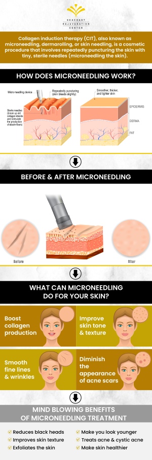 RF microneedling uses the addition of an RF energy technology that is transferred through the tiny needles below the skin’s surface to the deep layers of tissue of the epidermis. Look younger with smoother skin. Talk to our team of professionals at Seacoast Rejuvenation Center today about RF microneedling and its benefits. Contact us today or visit us online to book an appointment. We are conveniently located at 101 Shattuck Way Suite #1 Newington, NH 03801. RF microneedling uses the addition of an RF energy technology that is transferred through the tiny needles below the skin’s surface to the deep layers of tissue of the epidermis. Look younger with smoother skin. Talk to our team of professionals at Seacoast Rejuvenation Center today about RF microneedling and its benefits. Contact us today or visit us online to book an appointment. We are conveniently located at 101 Shattuck Way Suite #1 Newington, NH 03801.